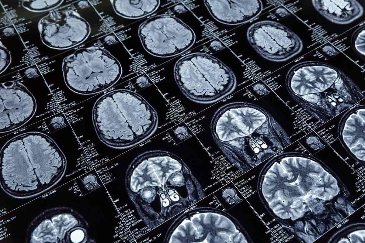 Topographie d'un cerveau atteint de la maladie d'Alzheimer