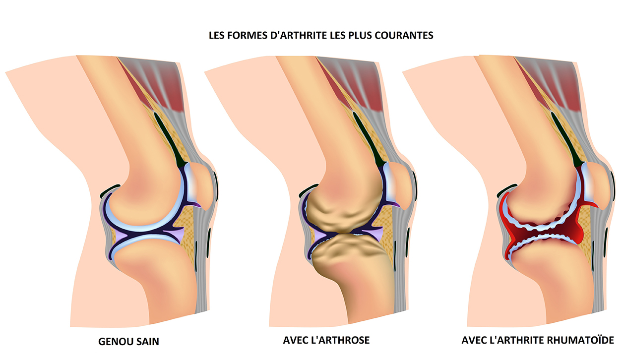 Différence entre un genou sain, un genou avec arthrose et un genou avec l'arthrite rhumatoïde.